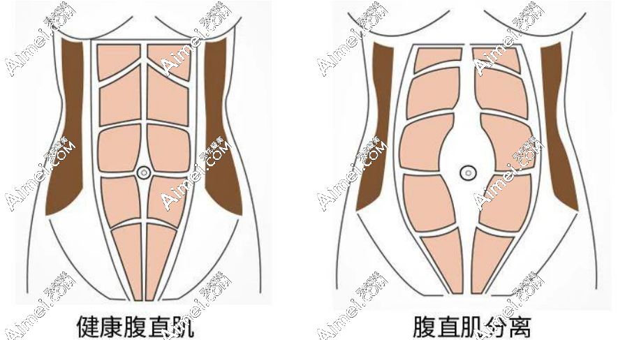 成都腹壁成形医生排名头一个是李献和-坐诊医院地址是武侯区成都现代医院
