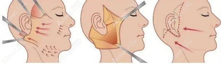 拉皮示意图