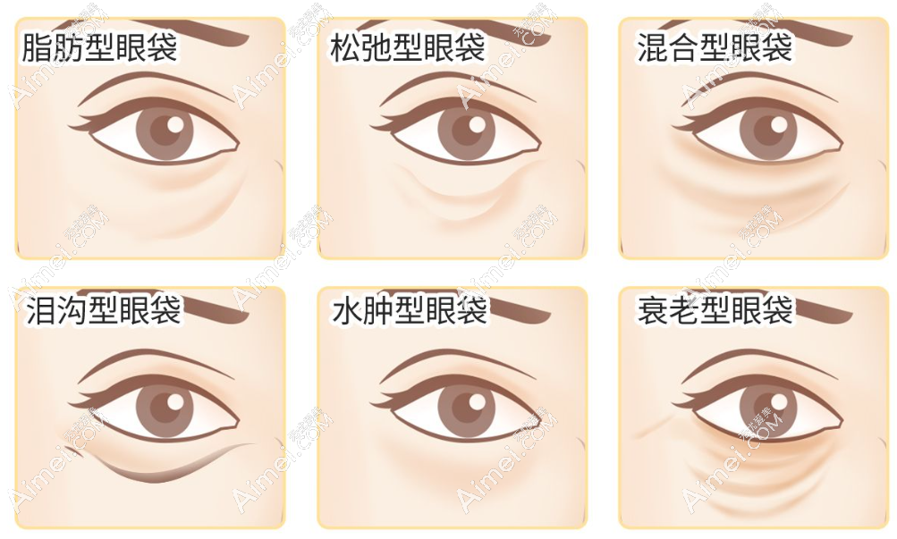 郑州修复眼袋哪个医生修的好