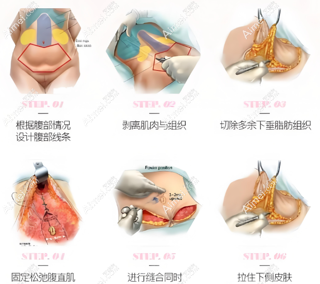李献和腹壁成型怎么样