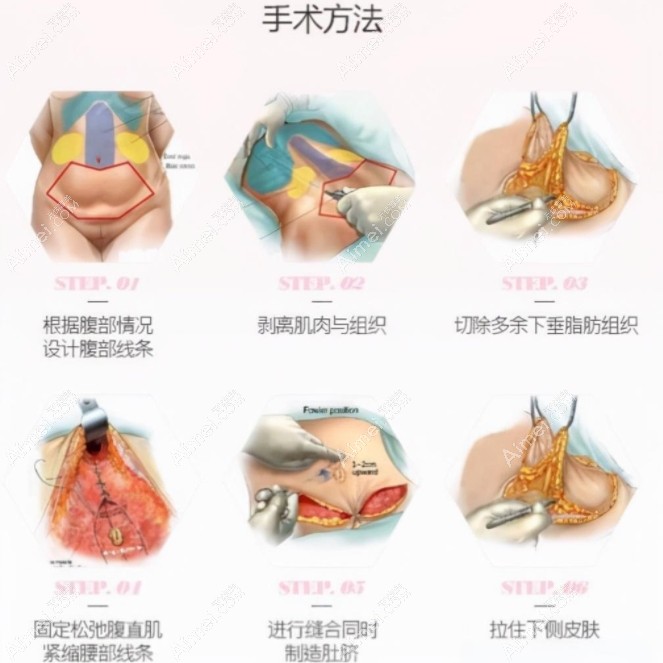 李献和腹壁整形的手术原理