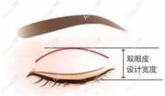 大连割双眼皮失败修复好的医生 大连割双眼皮失败修复好的医生