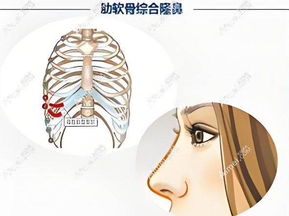 鼻整形手术