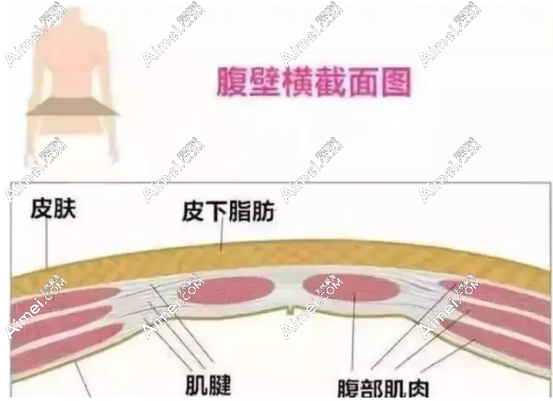 aimei.com腹壁成形手术