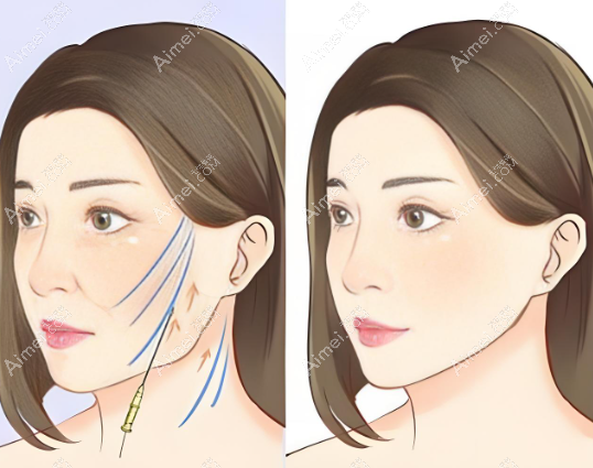 袁强拉皮技术好几乎没有负面口碑www.aimei.com