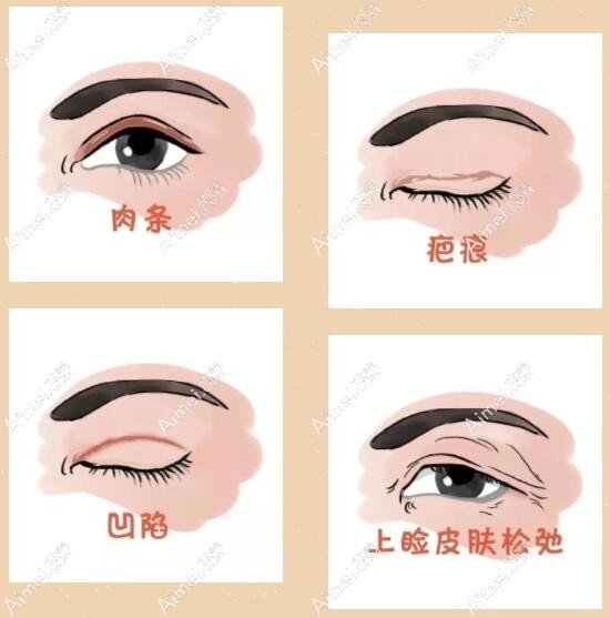 武汉谭琳双眼皮及双眼皮眼综合修复做得怎么样