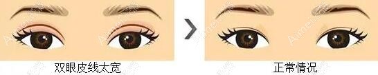 武汉谭琳医生双眼皮修复真人实例