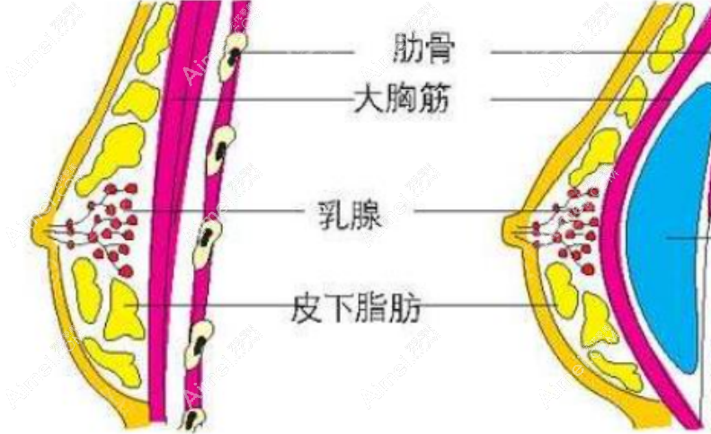 罗盛康隆胸技术好排名国内前十，属于福田区有名的隆胸医生