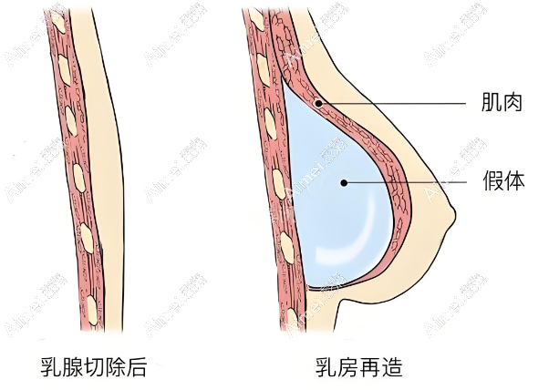 国内乳房再造手术已经比较成熟