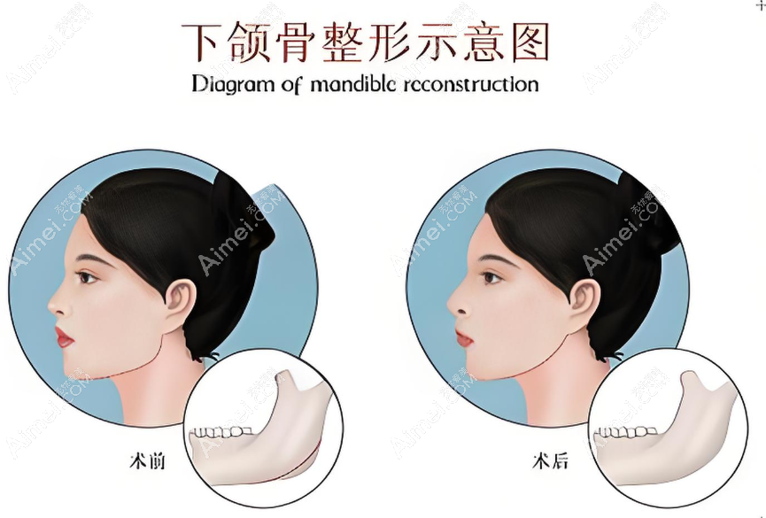 罗恩磨骨正颌几乎没有失败实例www.aimei.com