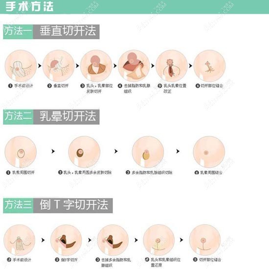 曾昂医生做缩胸手术的原理图