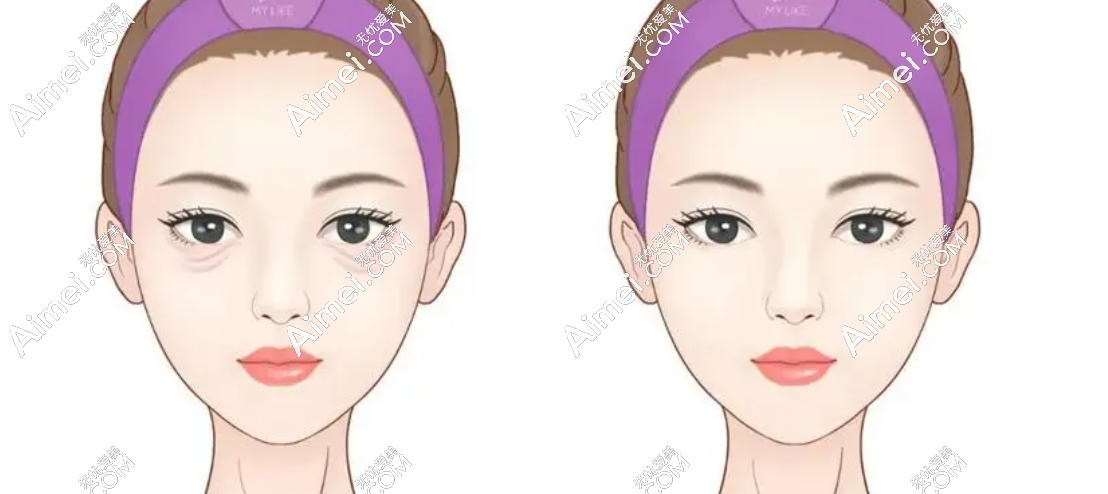 贺洁修复眼袋下翻的实例分享:专门来郑州找贺洁做拉皮眼袋修复,一点不后悔！ 爱美网