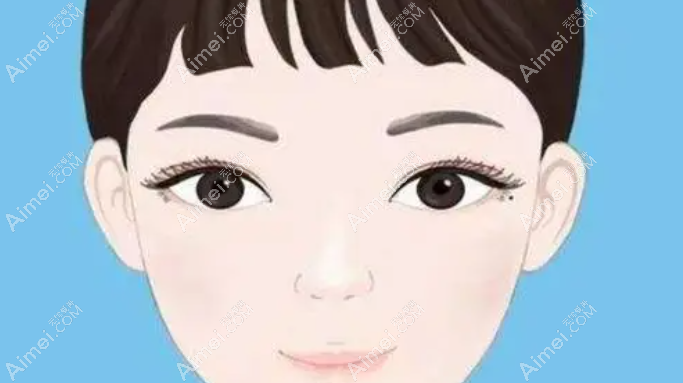 北京师丽丽修复双眼皮实例可信 北京师丽丽修复双眼皮实例可信