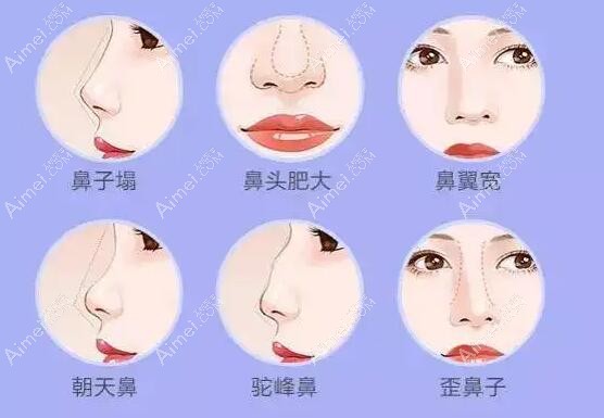 杭州艺星张龙做鼻子价位贵吗