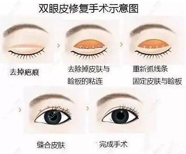 郑小红医生做双眼皮修复的原理图