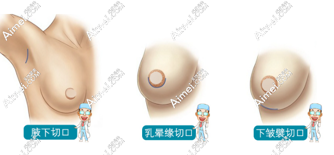 隆胸不同手术切口