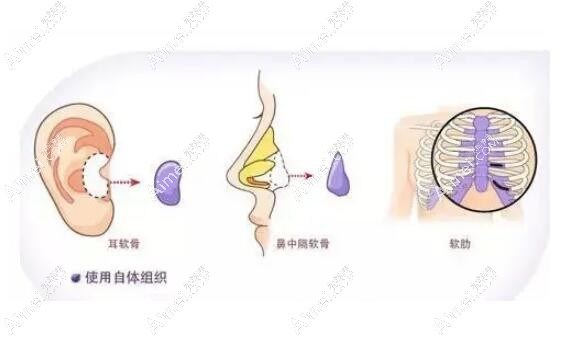 杭州艺星张龙做鼻子技术好，真人找张龙做自体肋软骨隆鼻失败修复很成功