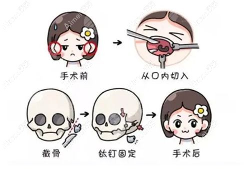 成都李继华磨骨怎么样
