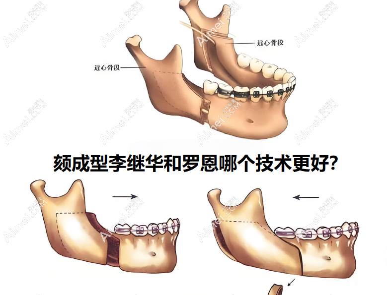 颏成型李继华和罗恩哪个技术更好?客观说李继华资历比不过,但胜在价格更便宜些