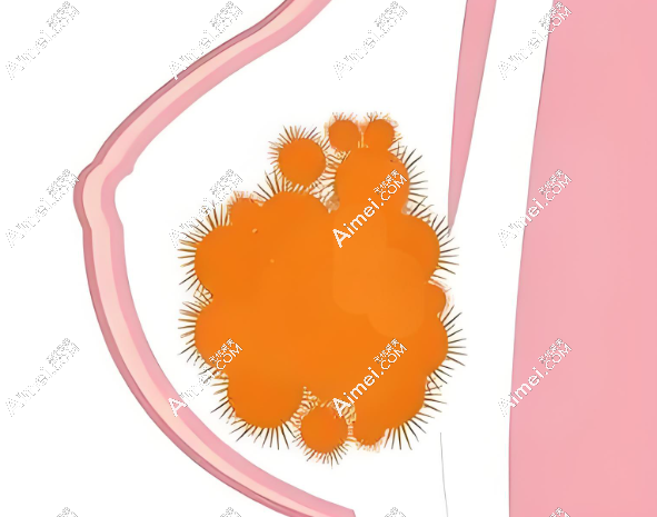 英捷尔法勒注射隆胸取出好的医院名单 m.aimei.com