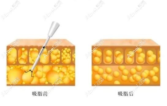 成都腰腹部环吸抽脂医院排名前十出炉：军大、怡脂等吸脂技术口碑好的医院上榜