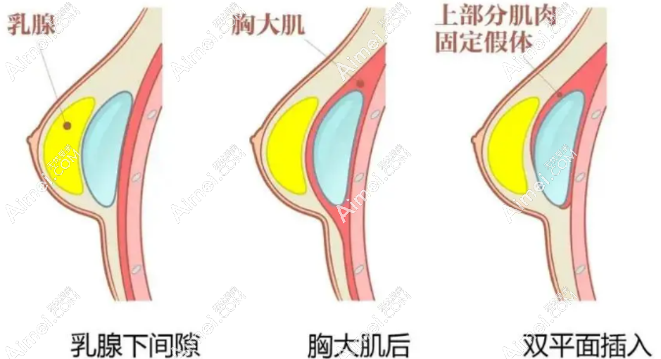隆胸手术示意图 隆胸手术示意图