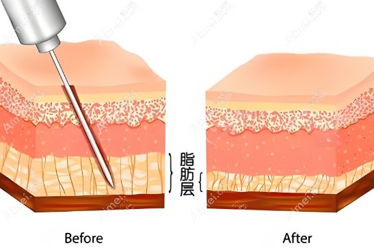 王自谦脂肪移植医生在线预约www.aimei.com
