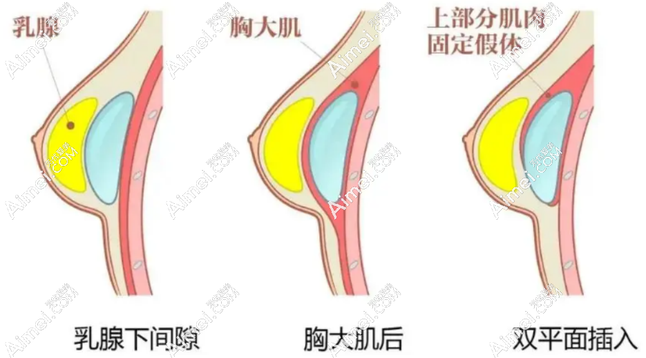 aimei.com深圳顾伟明医生隆胸