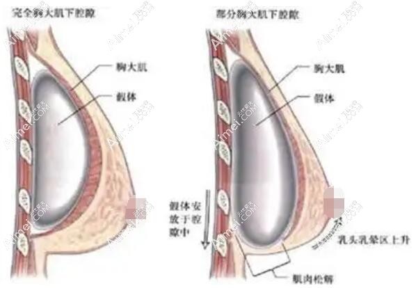 广州海峡闫爱跃医生做假体隆胸手术怎么样 广州海峡闫爱跃医生做假体隆胸手术怎么样