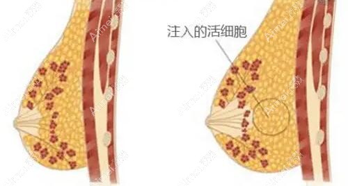 广州海峡闫爱跃医生做自体脂肪丰胸手术技术好 广州海峡闫爱跃医生做自体脂肪丰胸手术技术好