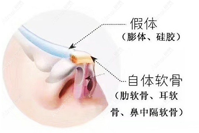 朱刚强医生在鼻部整形的技术优势