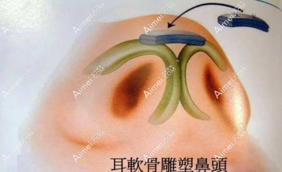 韩嘉毅医生隆鼻 韩嘉毅医生隆鼻