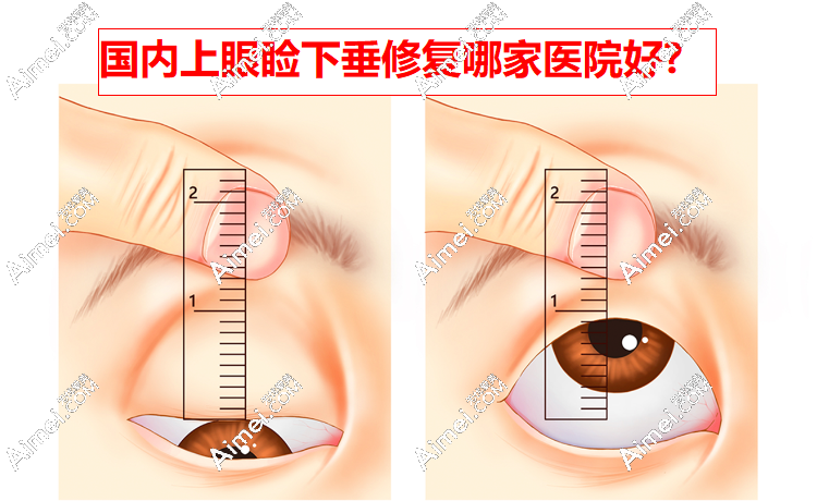 国内上眼睑下垂修复哪家医院好?前十地处北京西安武汉广州上海大连,市均价14125