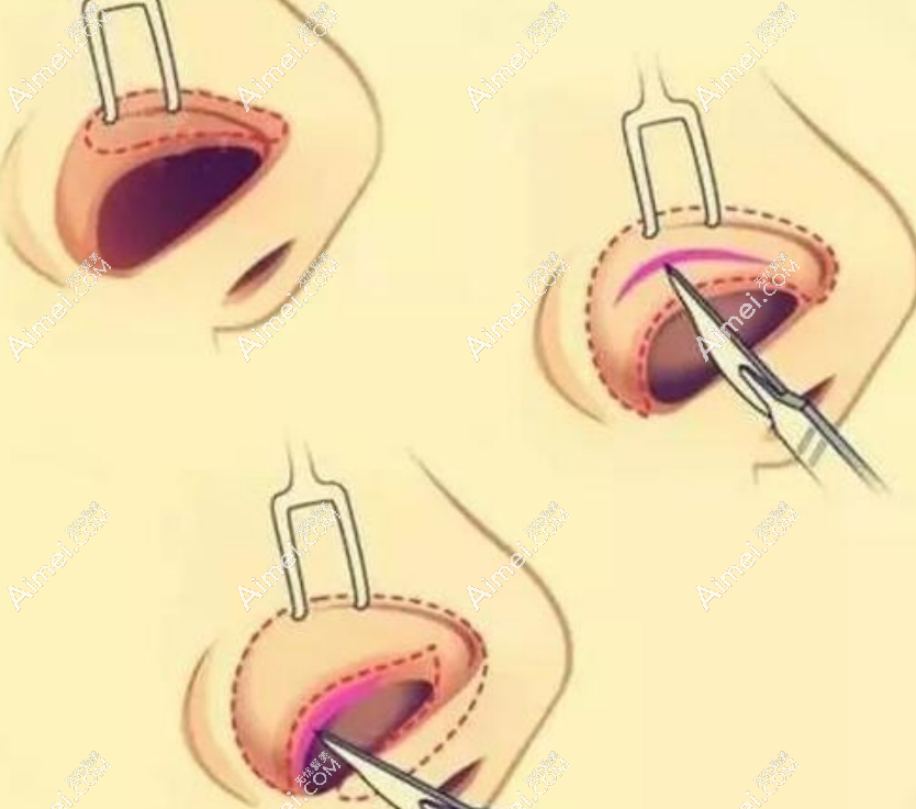 aimei.com上海华美医疗美容医院隆鼻 aimei.com上海华美医疗美容医院隆鼻