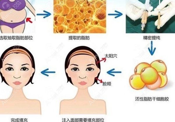 重庆松山医院整形科做脂肪填充面部很棒