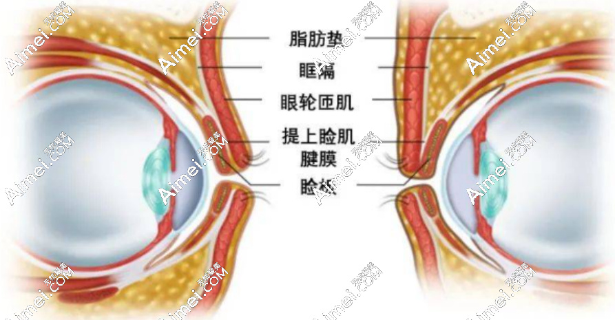 双眼皮手术 双眼皮手术