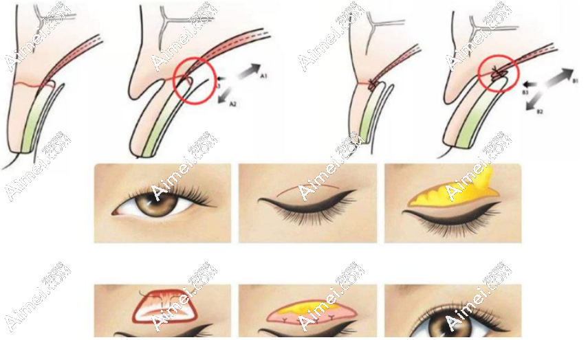 aimei.com双眼皮手术 aimei.com双眼皮手术