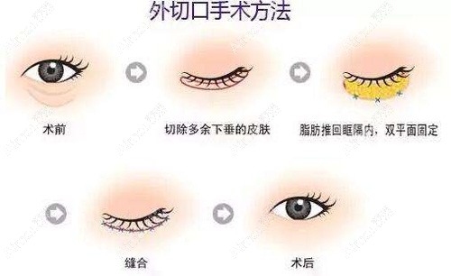 武汉去眼袋好的医院技术优势 武汉去眼袋好的医院技术优势