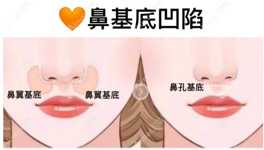 上海do鼻靠谱的医生排名：前三的范荣杰、李健、沈国雄do鼻挺好约的不用排队