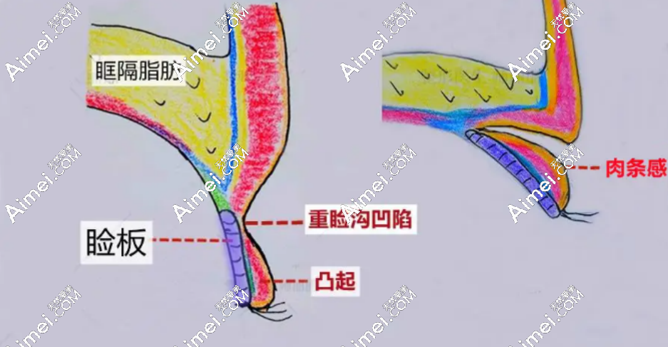 双眼皮手术 双眼皮手术