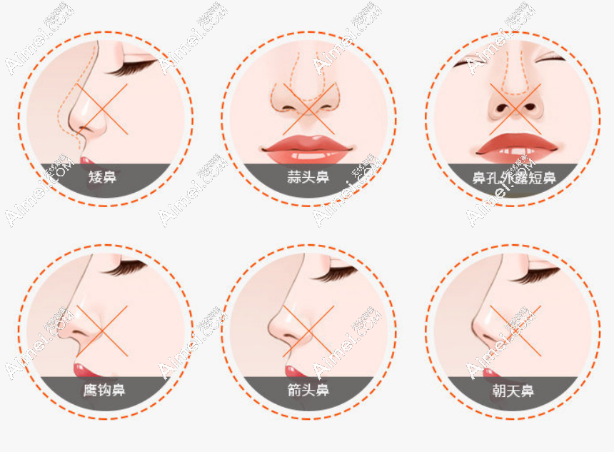 广州李明医生鼻子修复价格：李明作为广州专做鼻部的医生收费才3万起