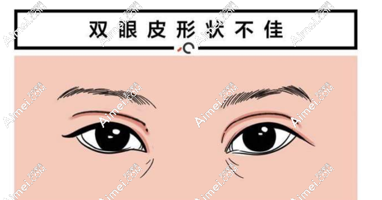 鄭小紅雙眼皮避雷還是種草?修復(fù)雙眼皮沒爆出過黑料超靠譜,我先種草了