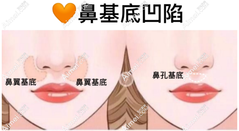 隆鼻示意图