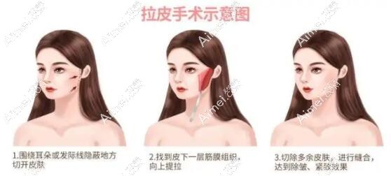 深圳南雅刘富增医生拉皮怎么样？