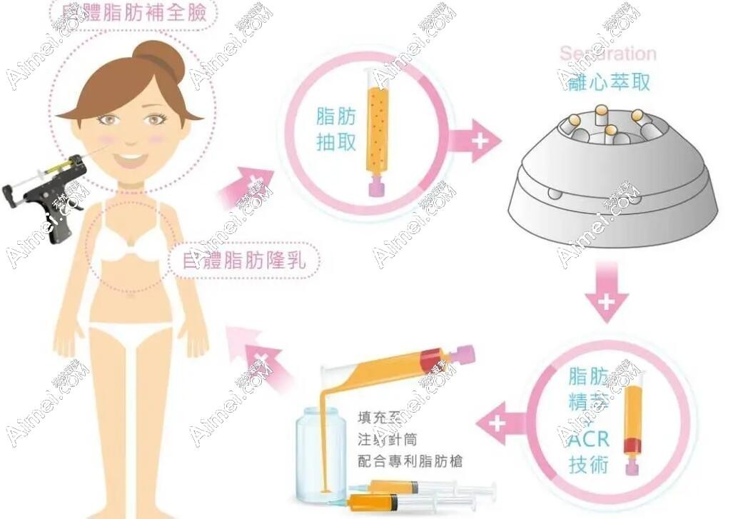 2024年北京自体脂肪隆胸价格在3万-6万元起