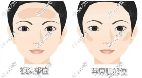北京纯脂王自谦填充价格