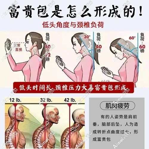 北京有没有治富贵包的医院.jpg