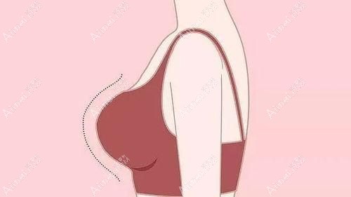 关于孙泽芳自体脂肪丰胸评价