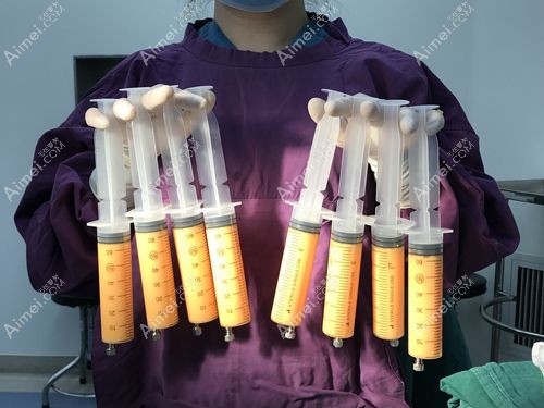 北京纯脂医疗美容门诊孙泽芳脂肪丰胸成效好
