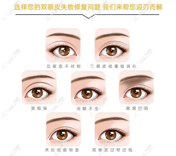 北京双眼皮及眼修复医院哪家好
